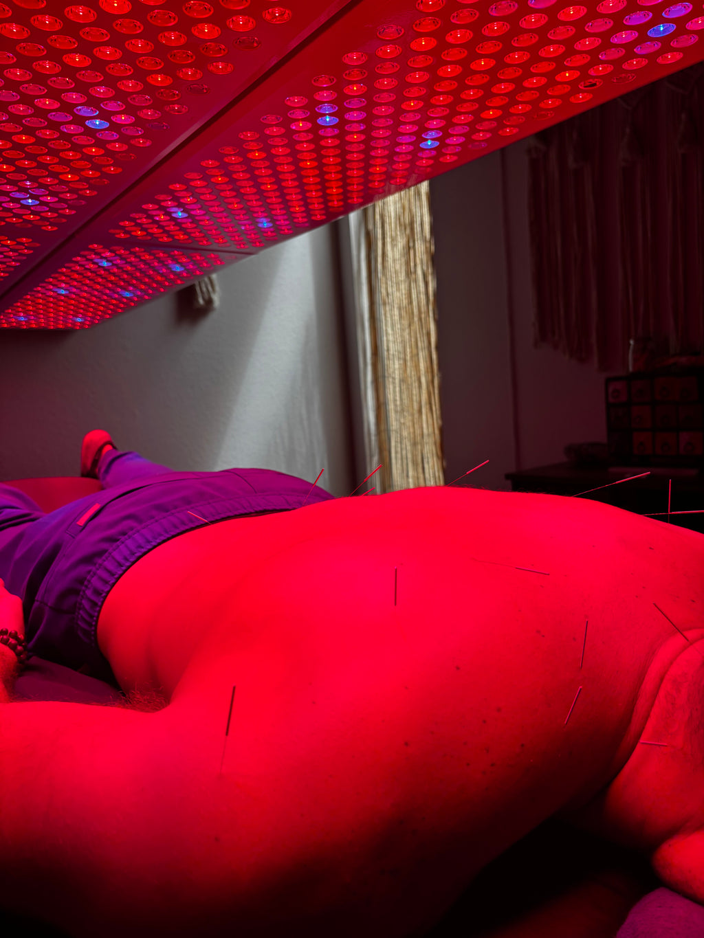 The Solarè Reset $45 - Acupuncture + RLT