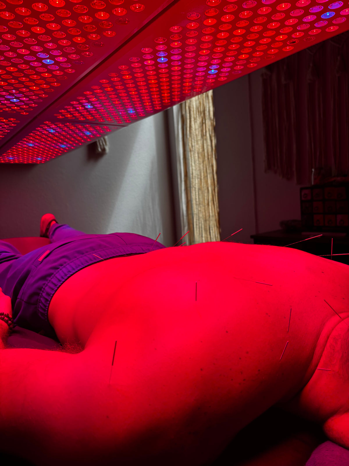 The Solarè Reset $45 - Acupuncture + RLT