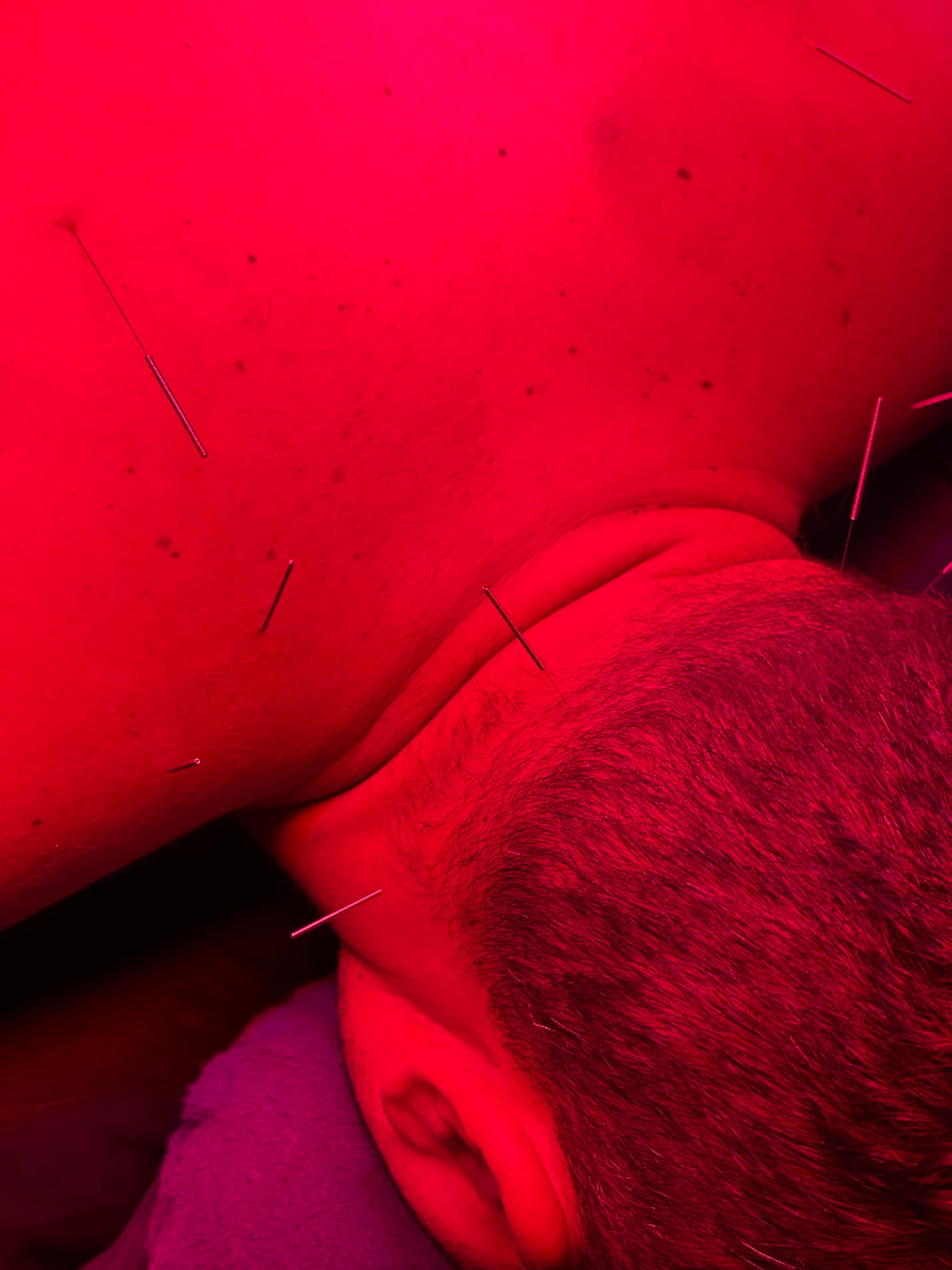 The Solarè Reset $45 - Acupuncture + RLT