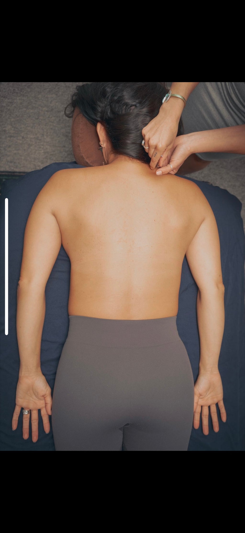 Private Acupuncture