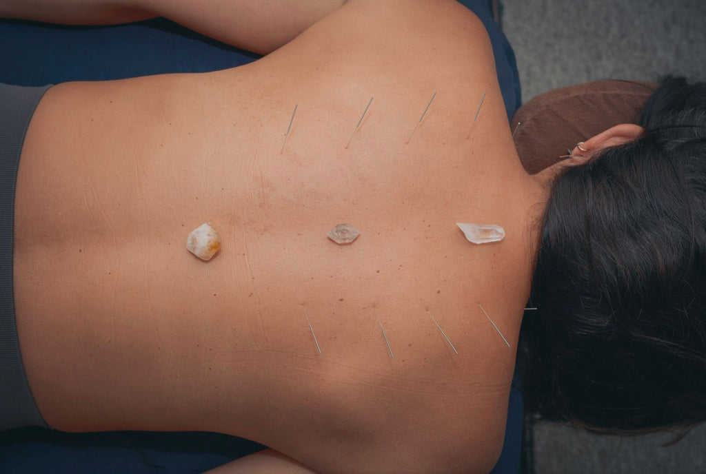 Private Acupuncture