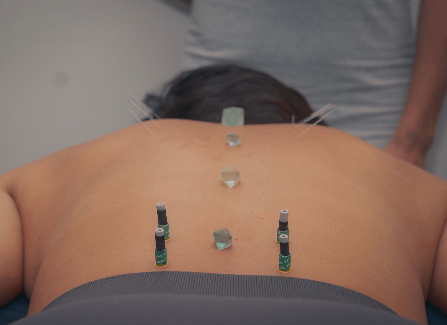 Private Acupuncture