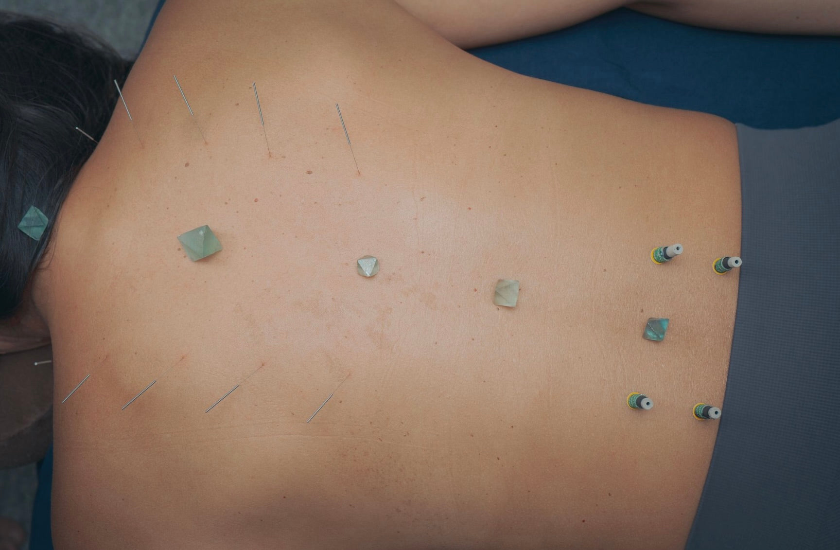 Private Acupuncture
