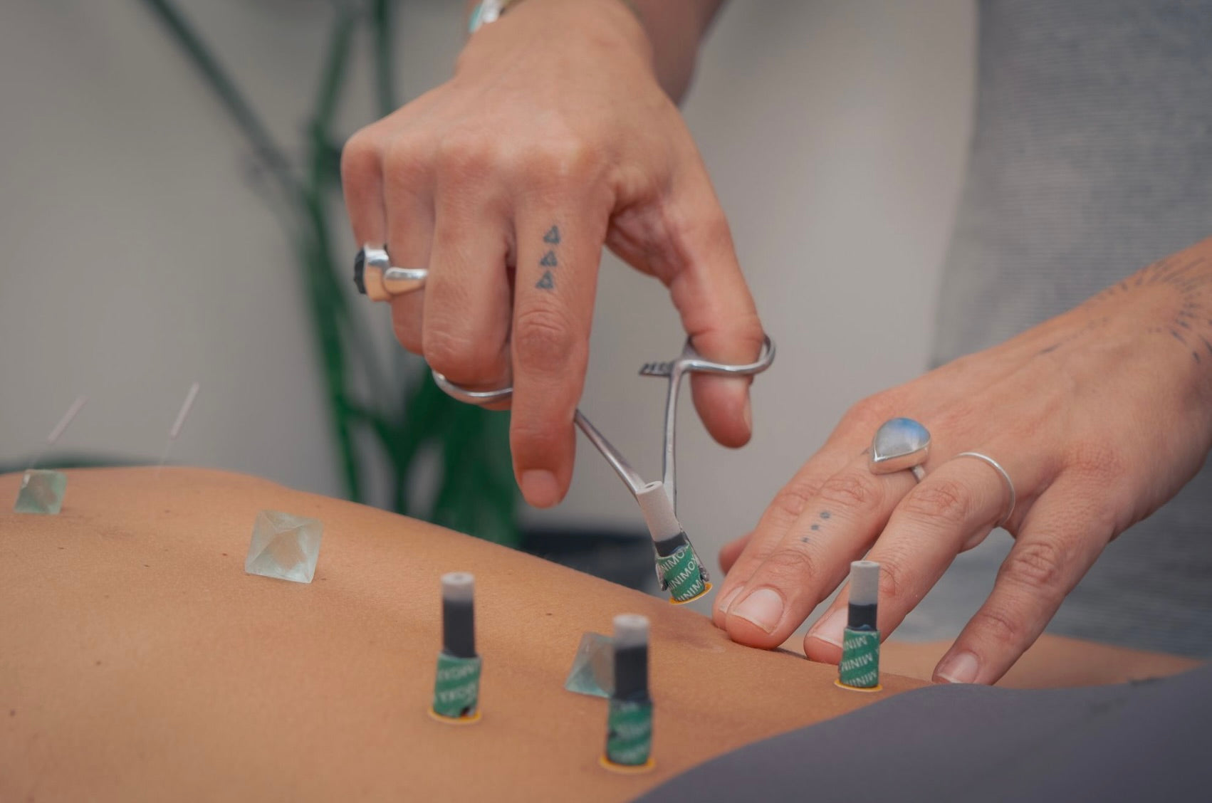 Private Acupuncture