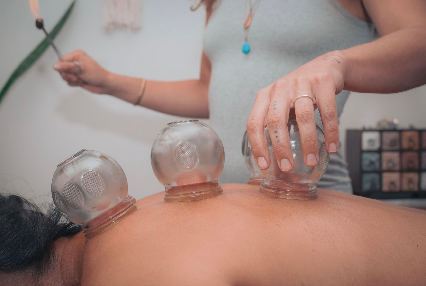 Fire Cupping